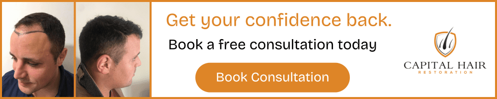 Before hair transplant photos showing hairline markings and side profile, with text encouraging booking a free consultation
