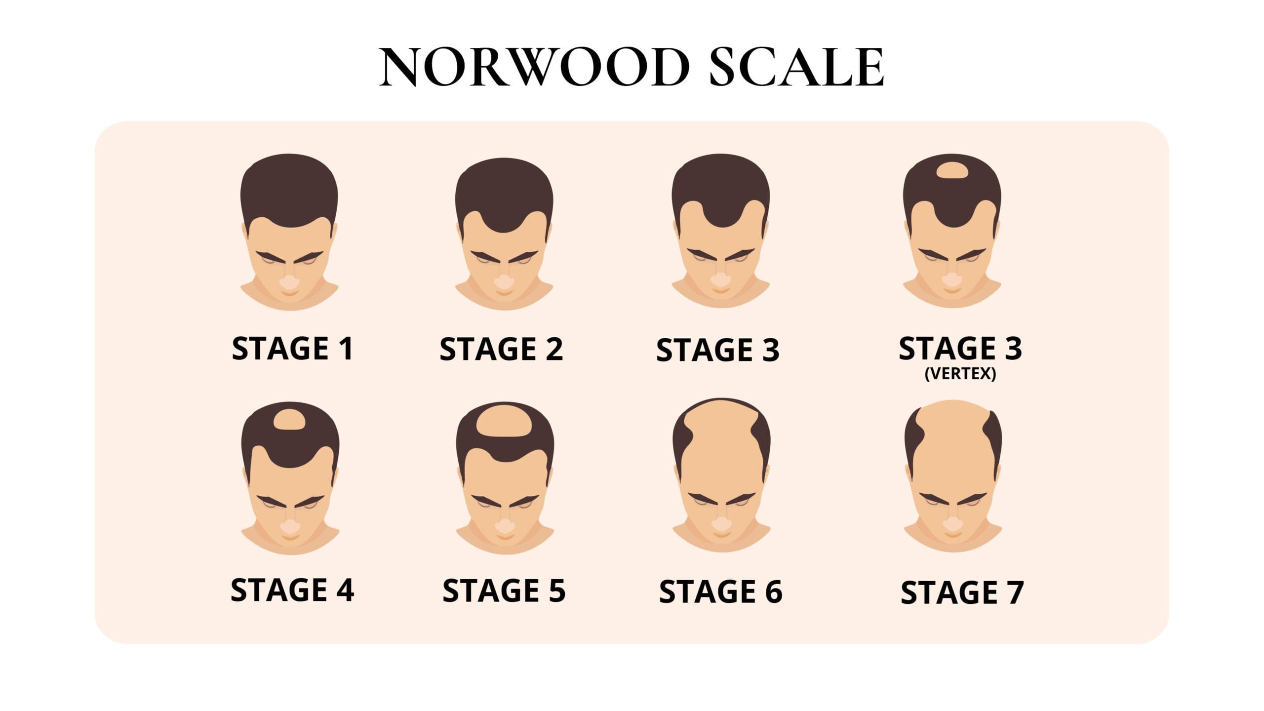 Diagram of the Norwood Scale with eight male head illustrations labeled Stage 1 through Stage 7, including a separate Stage 3 vertex, showing the progression of male pattern baldness from minimal to severe hair loss.