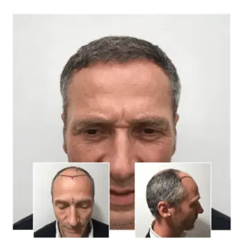 before after hair transplant luton 04