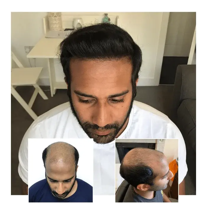 before after hair transplant milton keynes 02