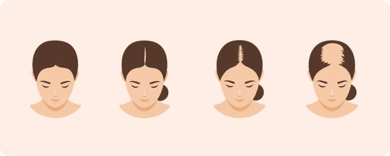 female pattern baldness